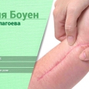 Боуен терапия при кожни белези